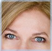 Forehead Lift (Endoscopic Brow Lift)